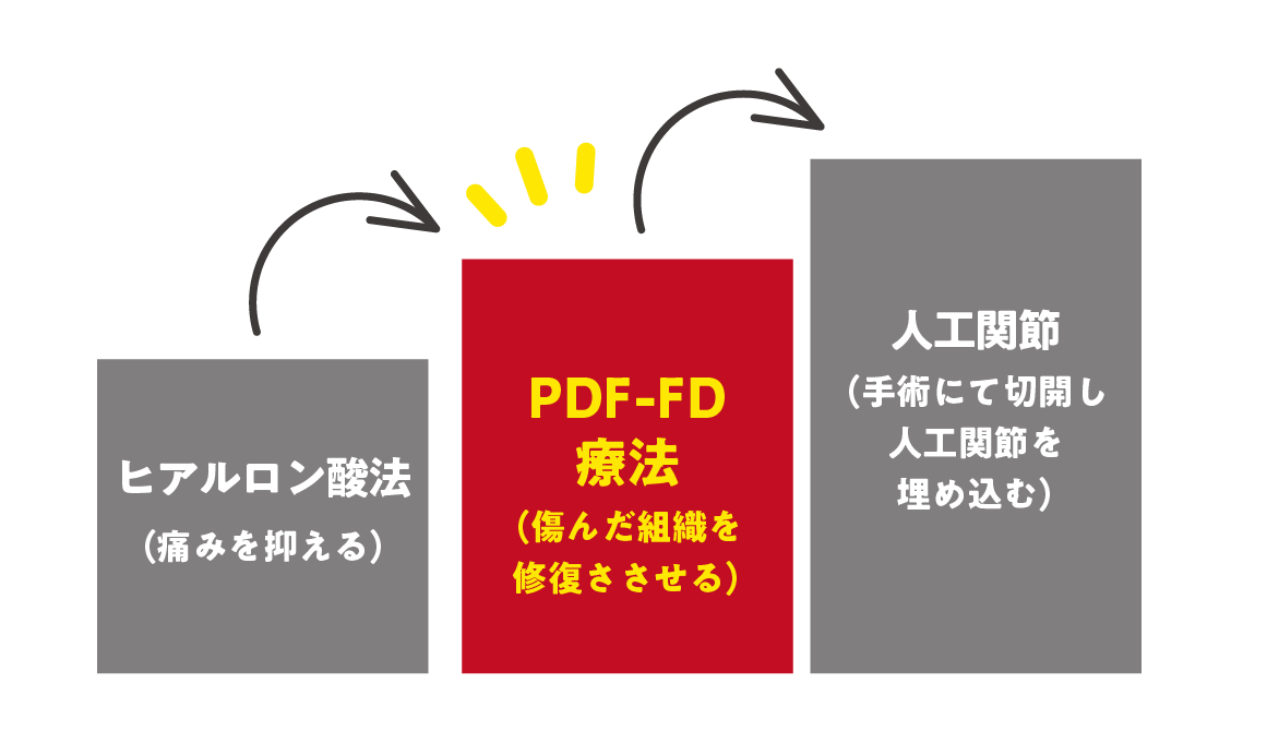 ヒアルロン酸療法、PDF-FD療法、人工関節の比較イメージ